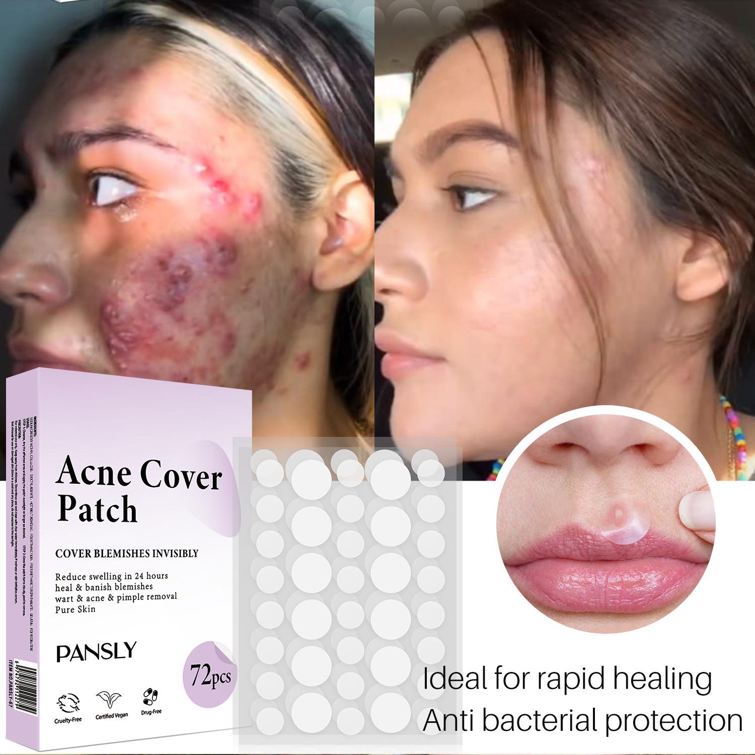 Pimple Removal Sticker 72Pcs Box